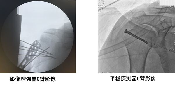 平板C臂更能满足骨科手术透视引导精准定位